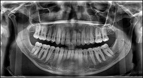X-Ray of my Chompers on February 9, 2011.